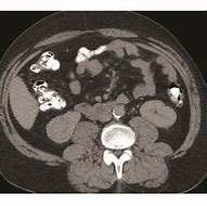 Image result for 4 Cm Mass On Kidney