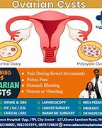 Image result for Ovarian Cyst Symptoms and Signs