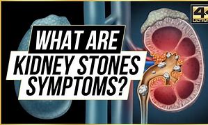 Image result for 2Mm Kidney Stone Pain