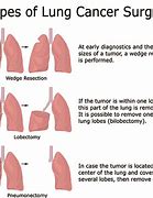 Image result for Chest Tumor Removal