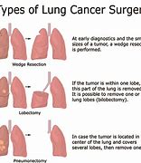 Image result for Lung Cancer Removed