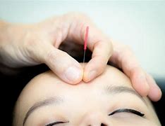 Image result for Japanese Acupuncture