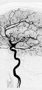 Image result for Cerebral Angiography