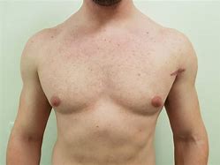 Image result for Pec Tear Bruise