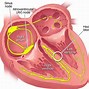 Image result for Right Bundle Branch Block