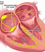Image result for Right Bundle Branch Block