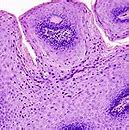 Image result for All Genital Wart Types