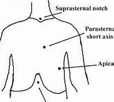 Image result for suprasternal notch pulse