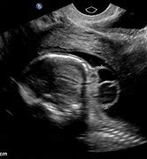 Image result for Cephalocele Ultrasound