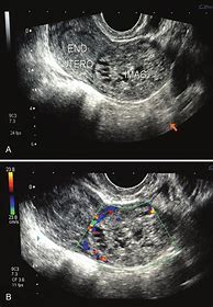 Image result for Complex Adnexal Mass