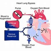 Image result for Heart and Lung Bypass