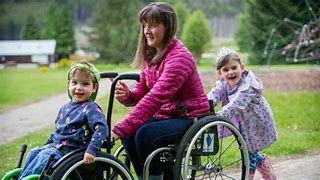 Image result for Spina Bifida with Hydrocephalus