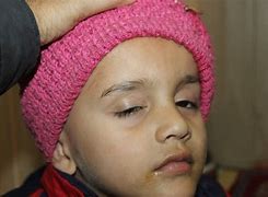 Image result for Molluscum Removal On Eye