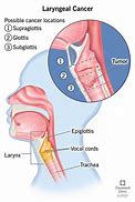 Image result for Laryngeal Papillomatosis Symptoms