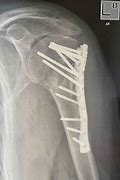 Image result for Humerus Bone Fracture Healing