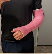 Image result for Pink Arm Cast