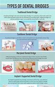 Image result for Types of Dental Bridges UK