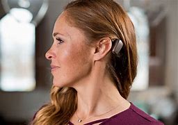 Image result for Cochlear Baha System