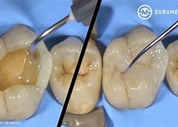 Image result for Dental Filling Procedure