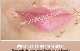 Image result for Filiform Wart in Mouth