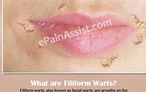 Image result for Filiform Warts