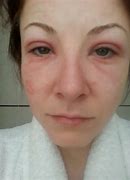 Image result for Allergic Reaction Face Swelling