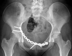 Image result for Groin Cysts Women