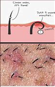 Image result for Ingrown Hair On Face