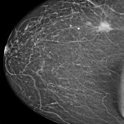 Image result for Spiculated Mass On Mammogram