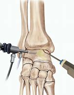 Image result for Posterior Ankle Arthroscopy