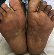 Image result for Rotting Feet