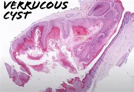 Image result for Peristomal Verrucous