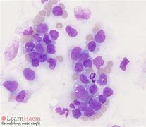 Image result for Acute Myelomonocytic Leukemia