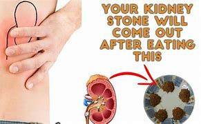 Image result for Kidney Stone Urine