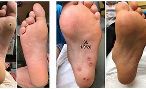 Image result for Treatment for Plantar Warts On Foot