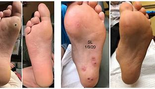 Image result for Stages of Wart Dying