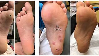 Image result for Healed Plantar Wart