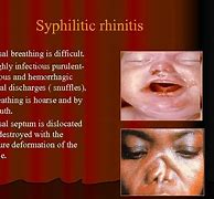 Image result for Syphilis Nose
