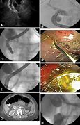Image result for Drainage Stent