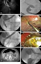Image result for Perc Biliary Drain