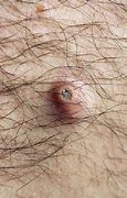 Image result for Small Sebaceous Cyst