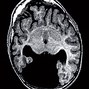 Image result for Cerebral Palsy vs Holoprosencephaly