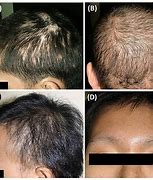 Image result for Syphilis Hair Loss