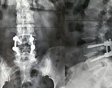 Image result for Vertebrae Fusion Surgery