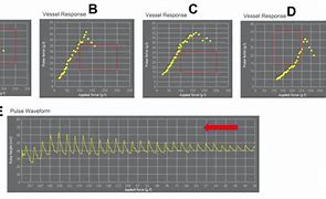 Image result for Cardio Intervellogram Sharp Rise and Fall