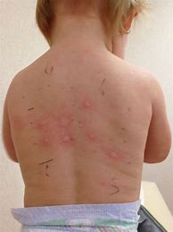 Image result for Copper Allergy Rash