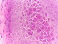 Image result for Molluscum Contagiosum Diagram