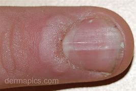 Image result for Fingernail Warts