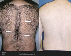 Image result for Laser Hair Removal Before and After