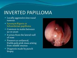 Image result for Papilloma Inside Nose